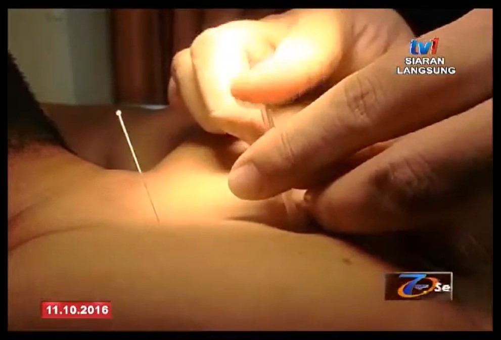 Rawatan Akupuntur