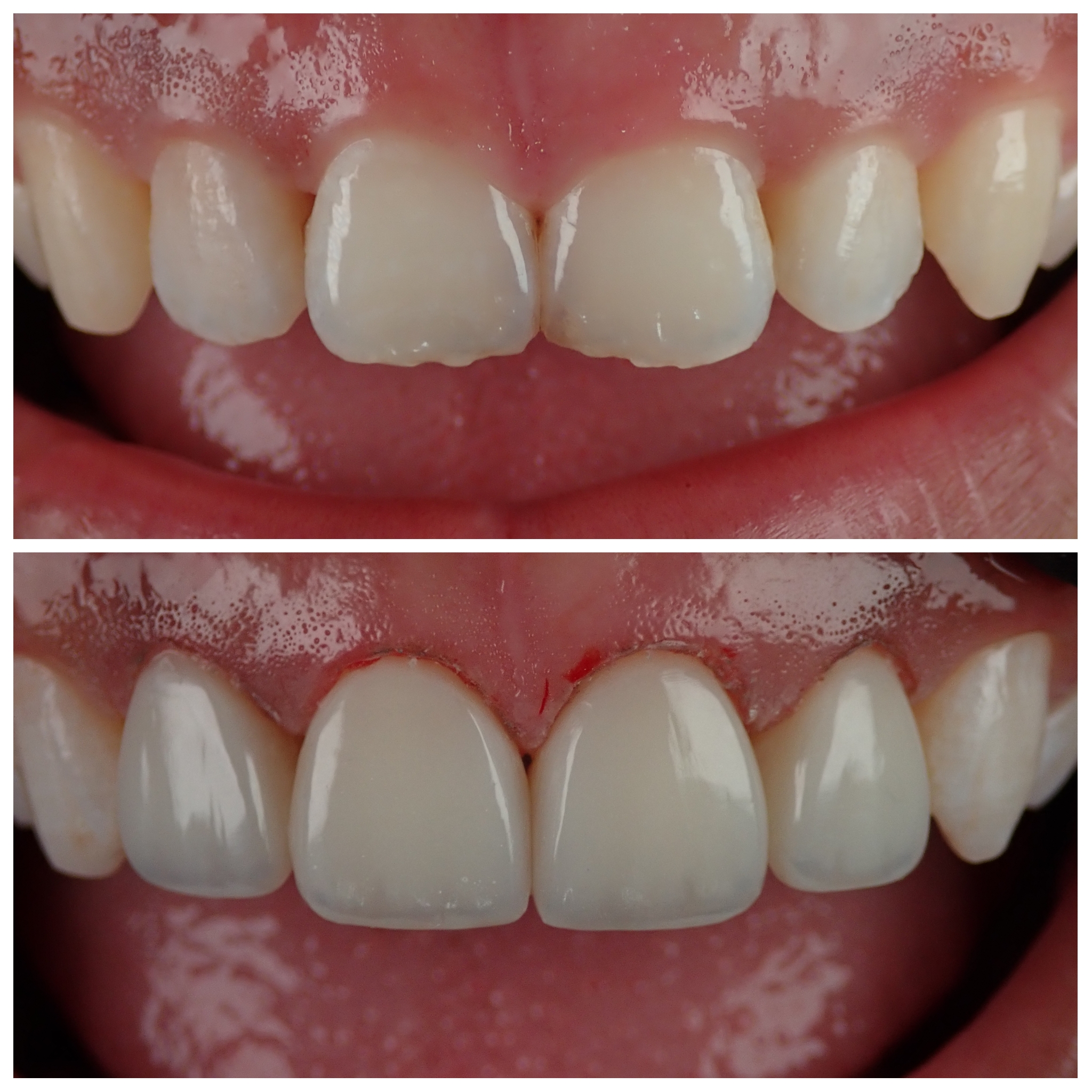 Hasil rawatan Sebelum dan Selepas Composite Veneer di Klinik Pergigian Dr Asri
