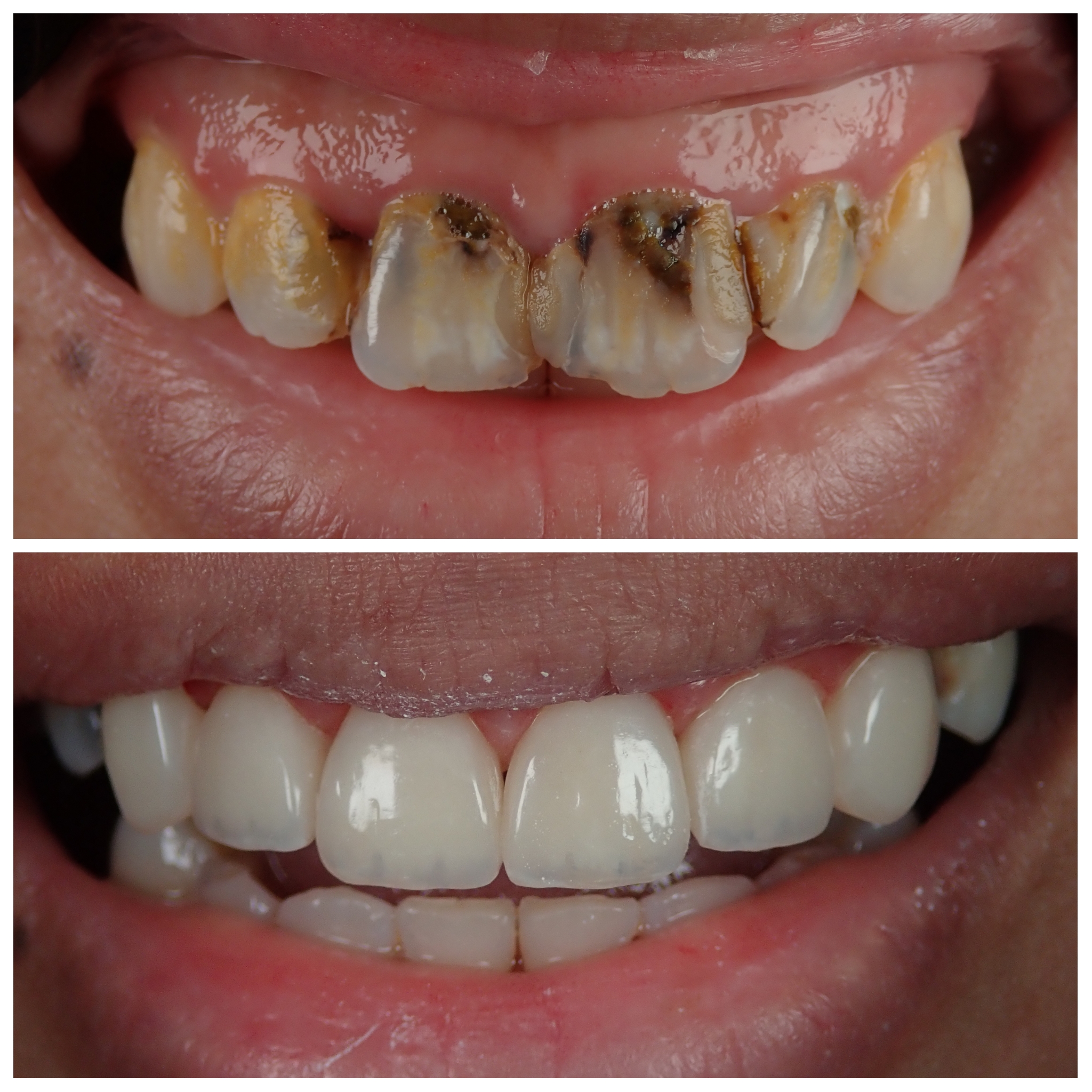 Hasil rawatan Sebelum dan Selepas Veneer Composite di Klinik Pergigian Dr Asri